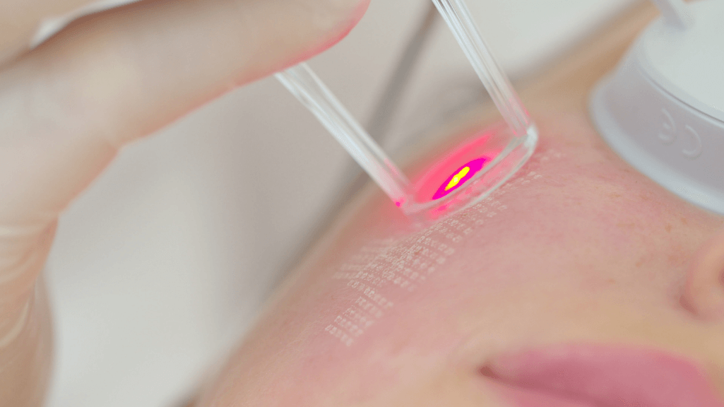 Laser skin resurfacing treatment for glow skin in Kuala Lumpur