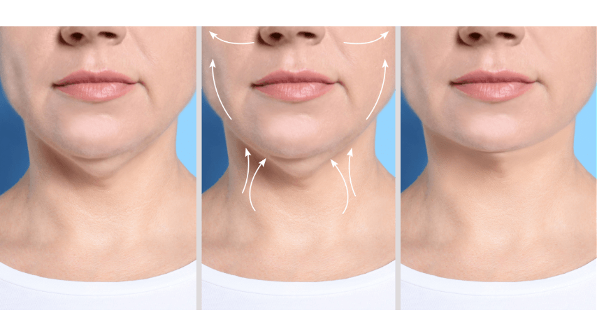 Microneedling before and after skin rejuvenation