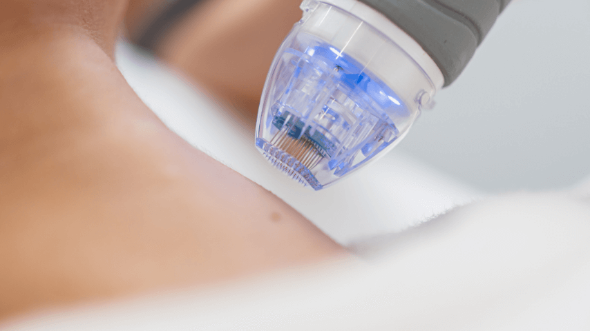 Close-up of RF microneedling device for wrinkle treatment