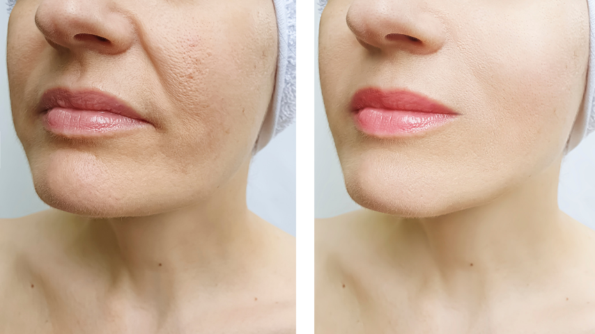 Skin boosters vs dermal fillers comparison image