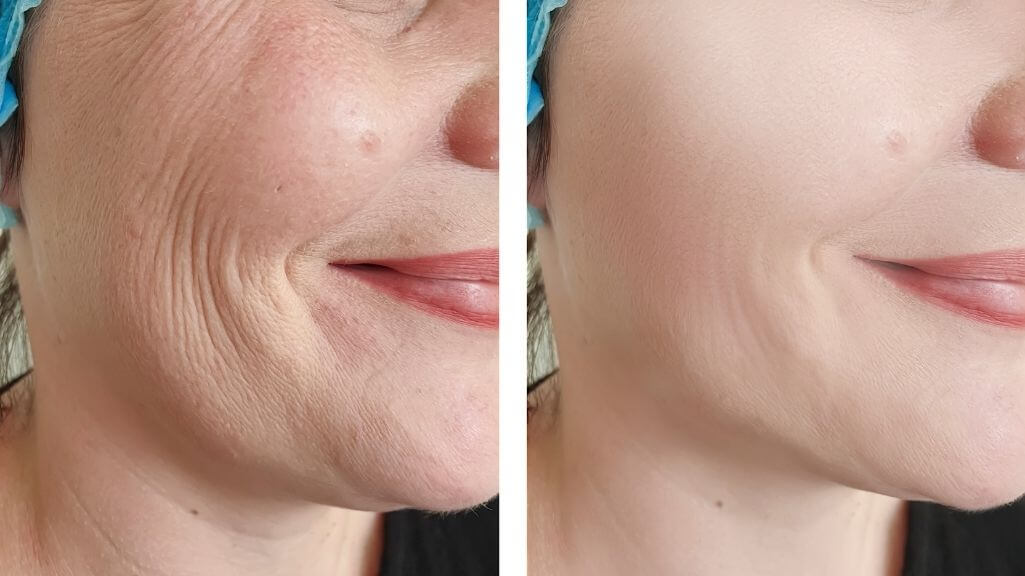 after.jpg	Before and after HIFU results showing improved facial contour