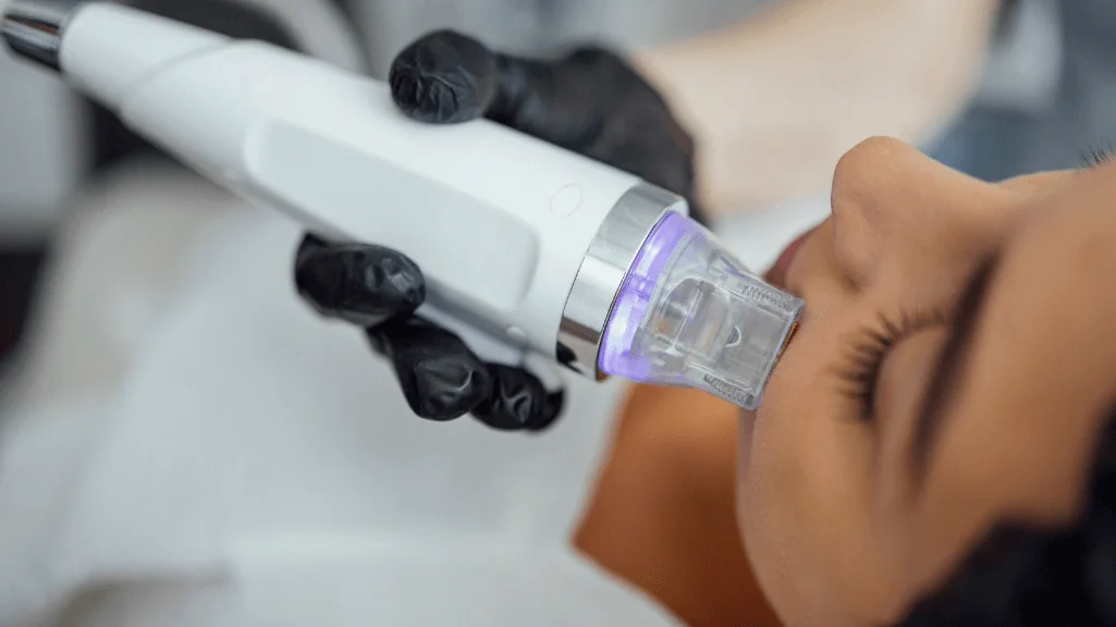 Woman receiving microneedling for anti-aging wrinkles