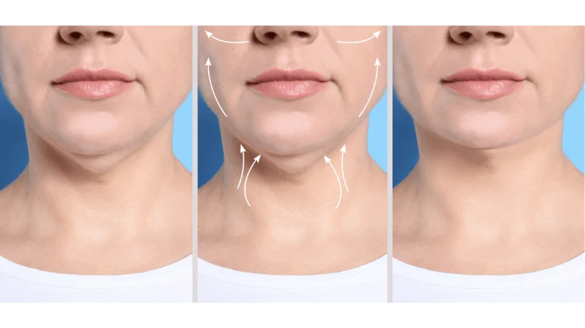 Microneedling before and after skin rejuvenation